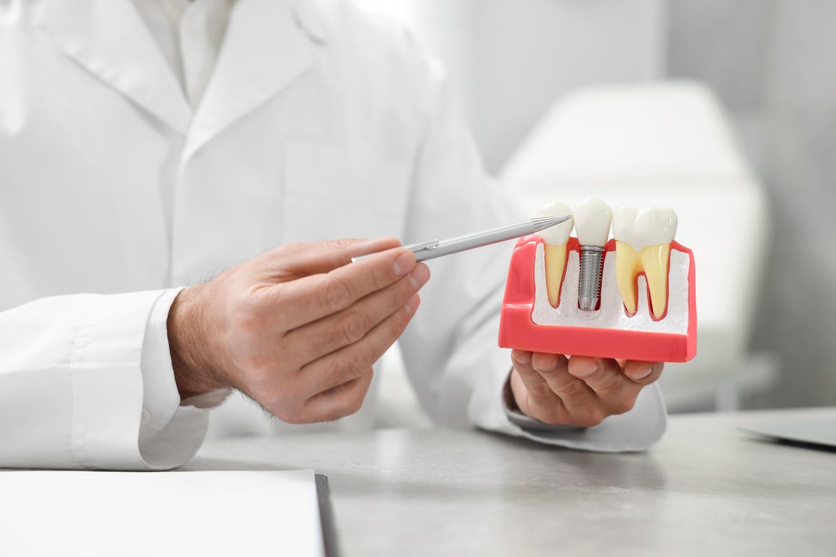 How to Know if You Need Dental Implants
