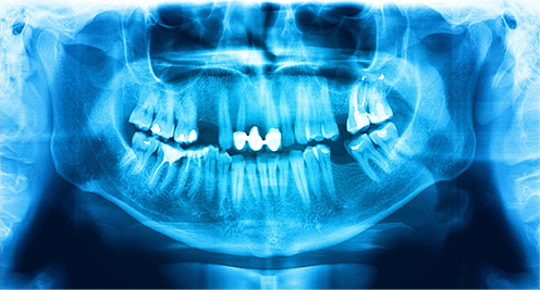 Special Dental Needs Cancer Patients
