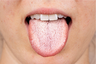 Special Dental Needs Cancer Patients