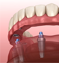 Special Dental Needs Cancer Patients