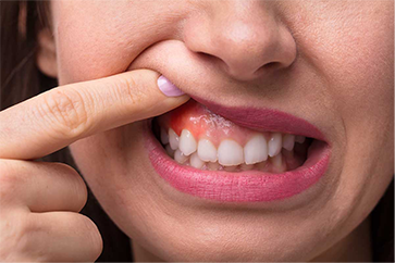 Special Dental Needs Cancer Patients